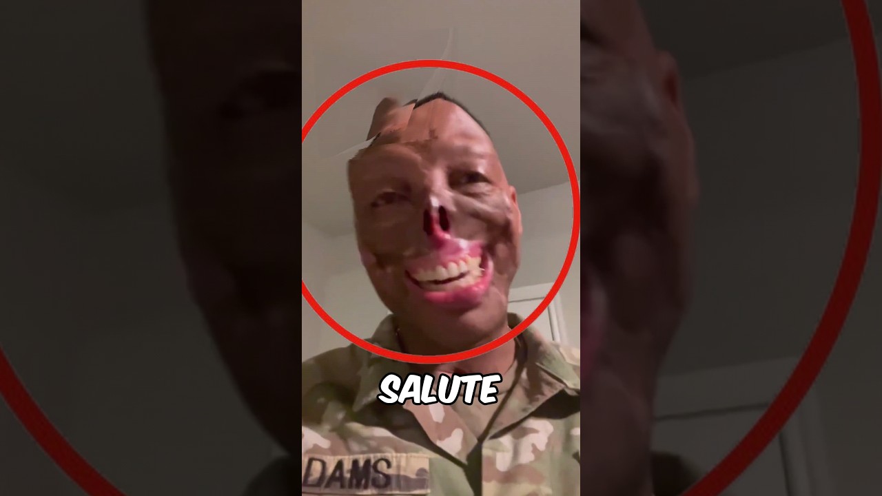 Этот солдат потерял лицо, спасая жизни🥺💔