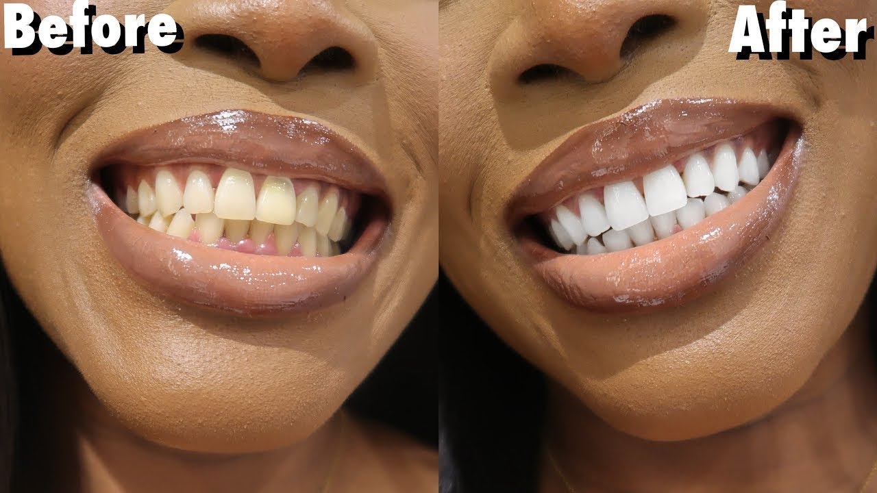 😮 How To: Teeth Whitening At Home NO Hydrogen Peroxide
