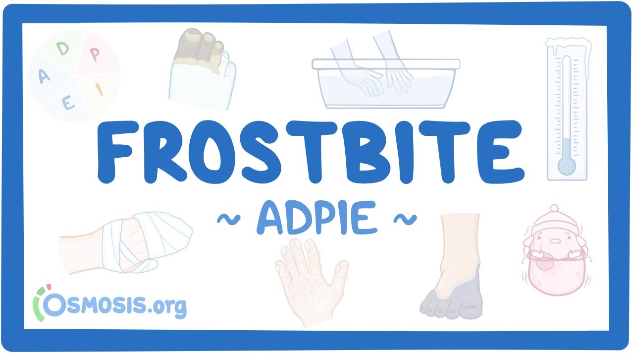 Frostbite: Nursing Process (ADPIE)