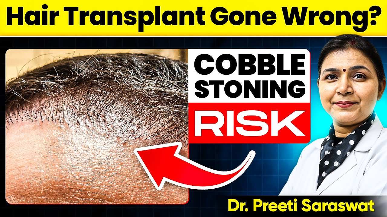 Неудачная пересадка волос? Риски и решения проблемы с булыжником от доктора Прити Сарасват
