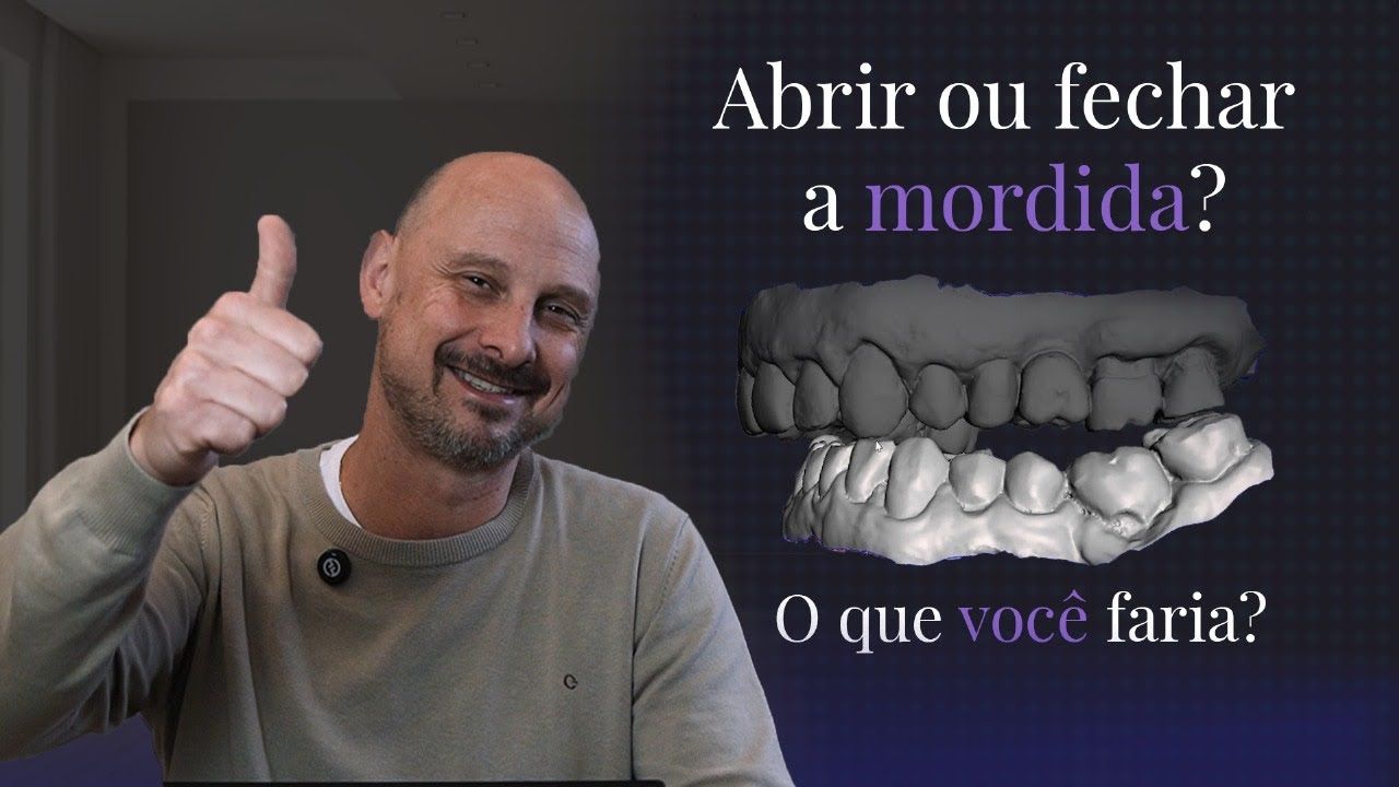 Ajuste de Oclus&atilde;o em Caso Complexo: Estrat&eacute;gias e Resultados na Odontologia Digital!