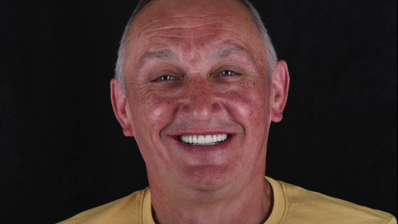 Keramički zubi boja B1