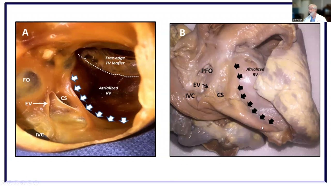 Ablation in Ebstein Anomaly