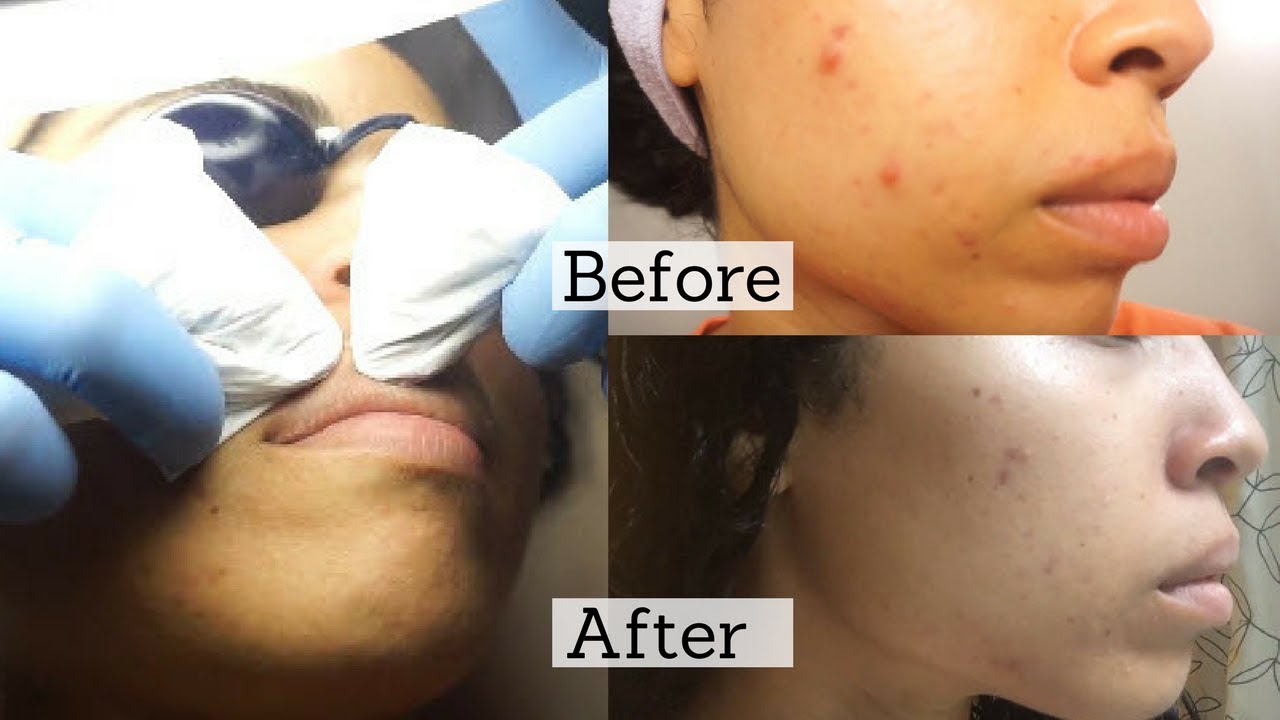 Facial Extractions: What You Need to Know | Before & After Results