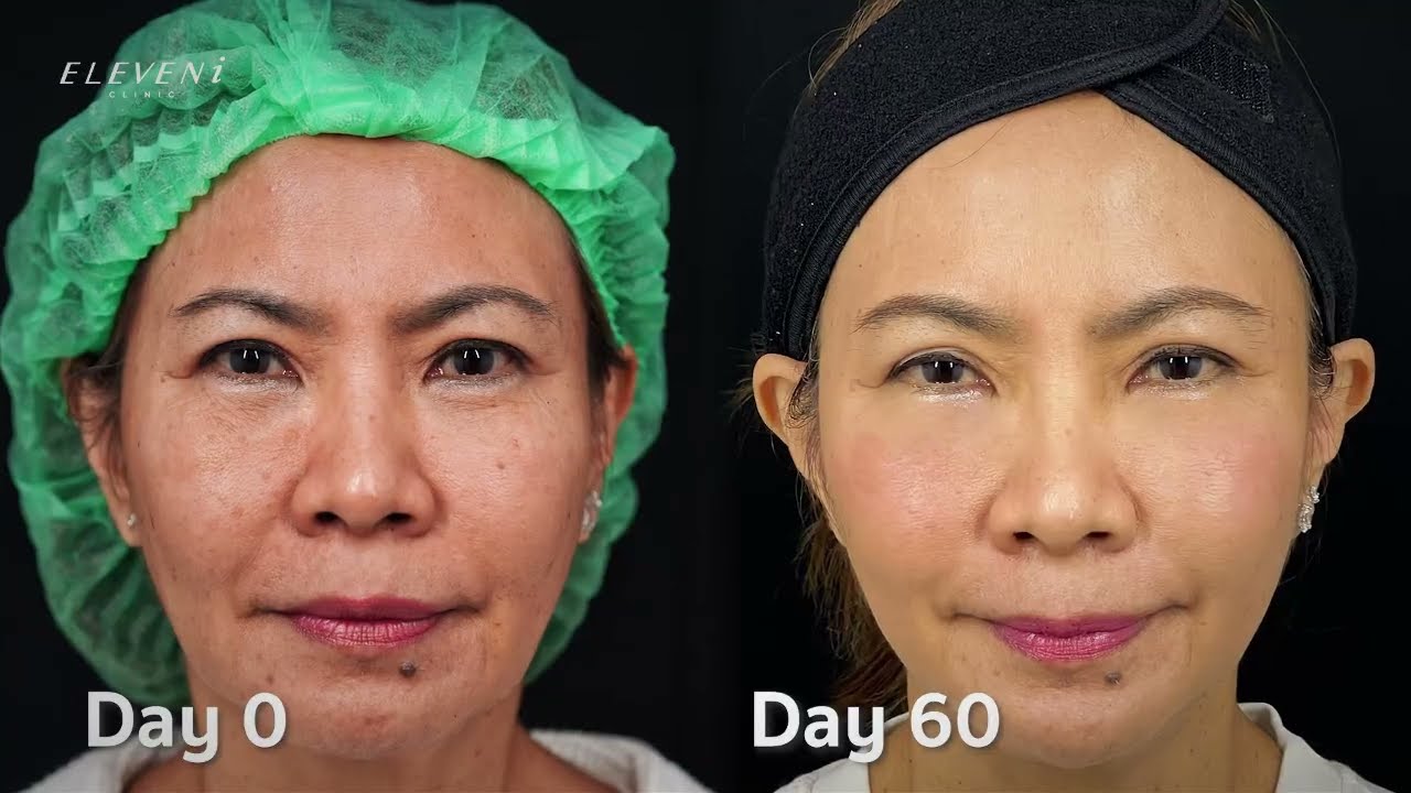 อยากสวยแบบไม่เจ็บ ไม่ผ่าตัด? เคส 60+ ทำได้จริงด้วยโปรแกรม Endolift X