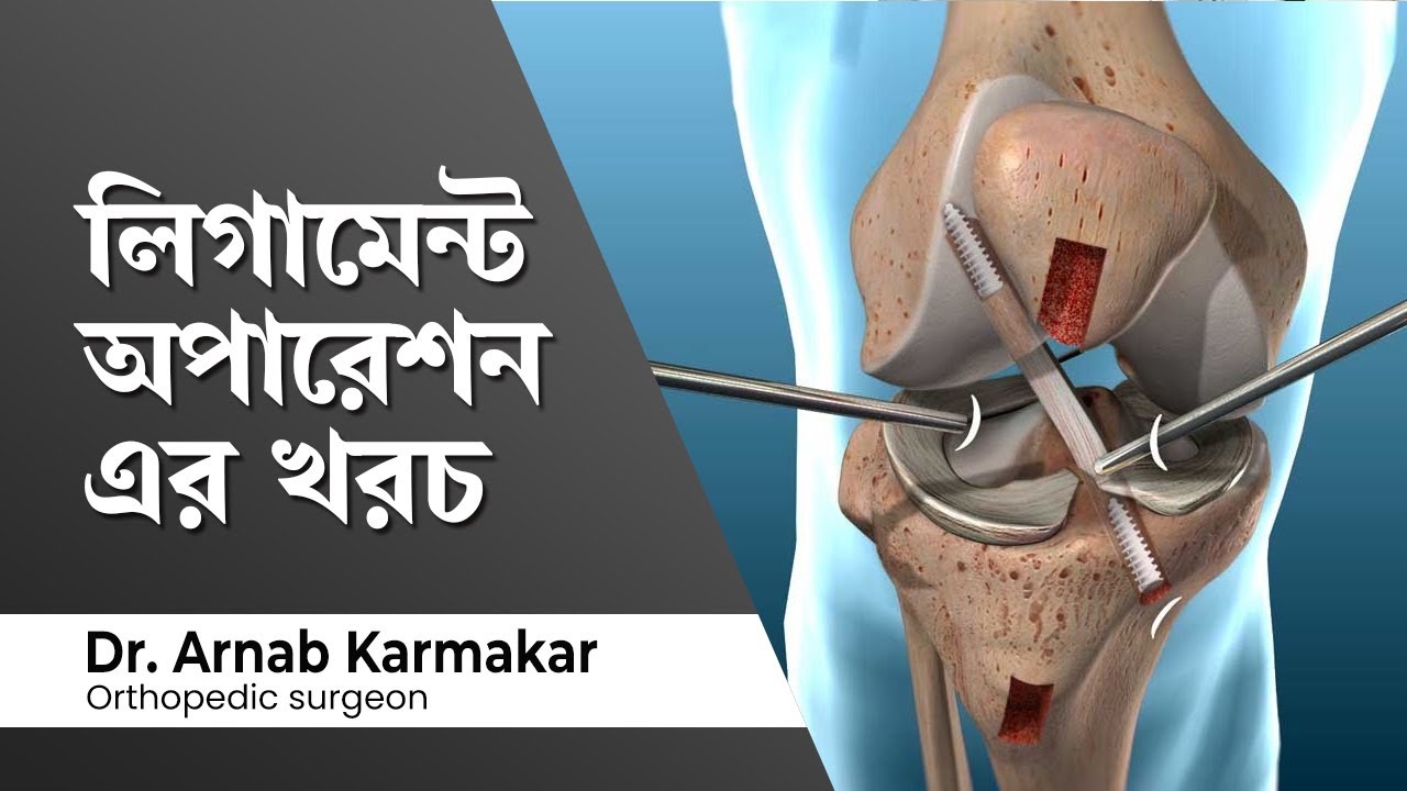 লিগামেন্ট অপারেশন এর খরচ  Knee Ligament Surgery Cost in India  Knee Arthroscopy Cost in Kolkata