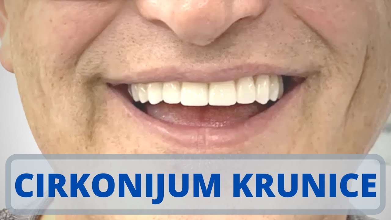 Hollywood smile - Osmeh iz snova - Cirkonijum keramičke krunice na implantatima