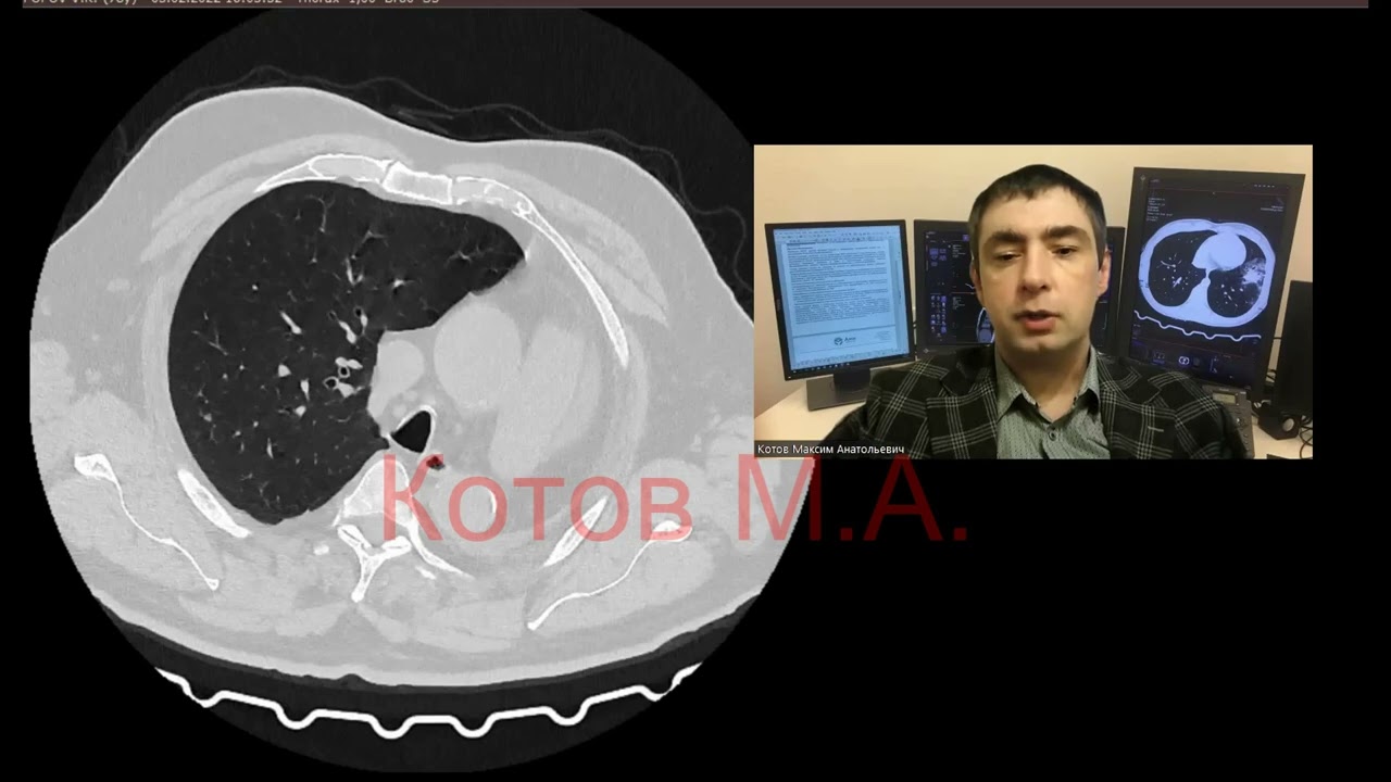 Состояние после пульмонэктомии. Ролик №32