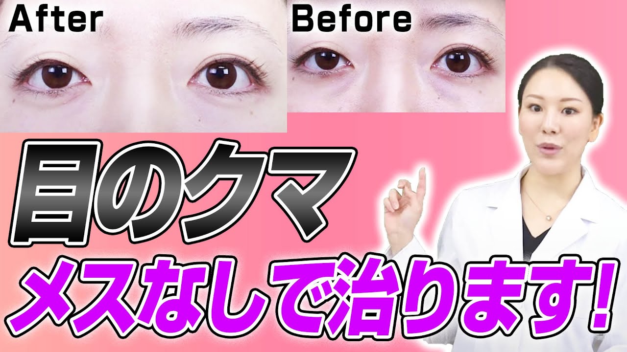 目の下のクマは手術なしで取れる!?