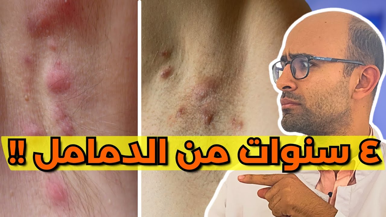 الدمامل تحت الابط ... مش مجرد دمامل ؟! - التهاب الغدد العرقية القيحي !