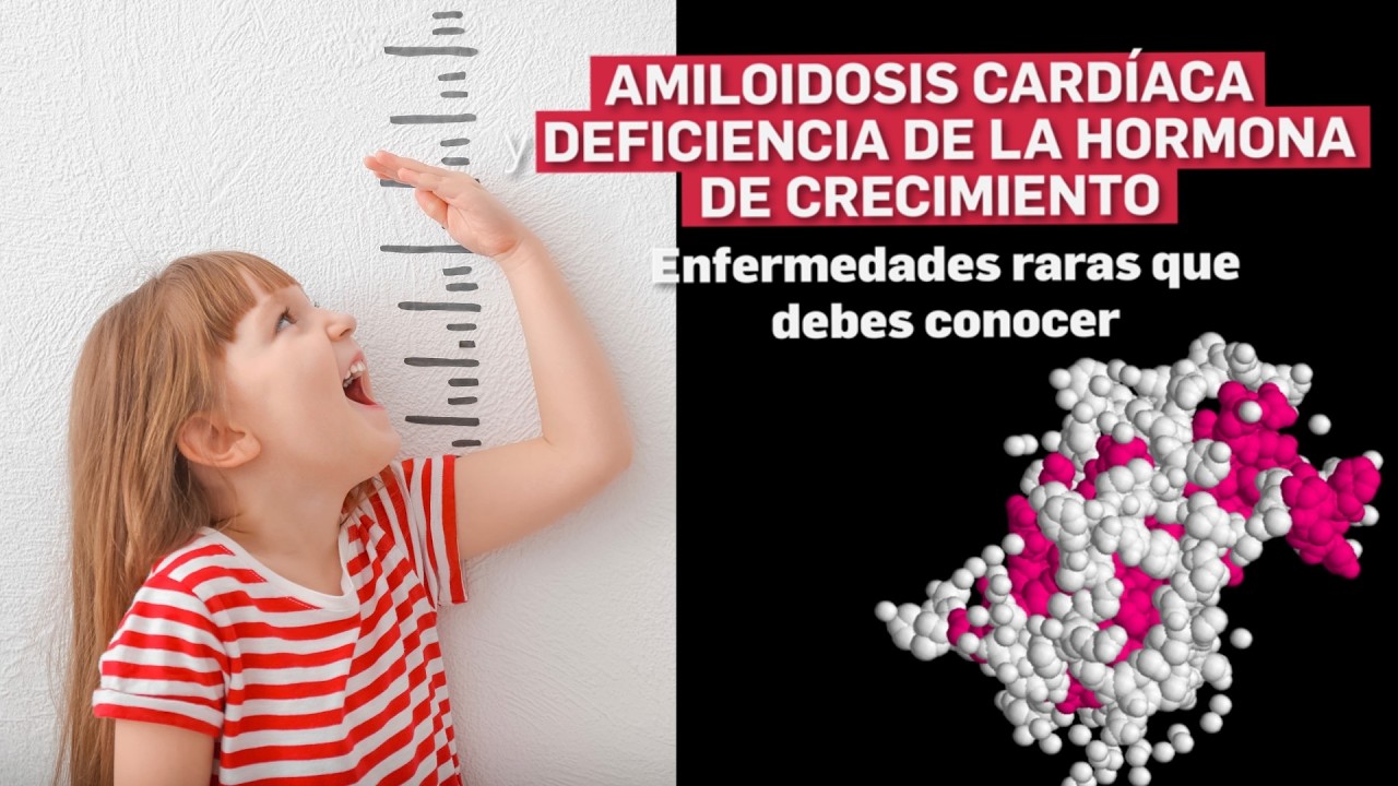 AMILOIDOSIS CARDIACA Y DEFISENCIA DE LA HORMONA DE CRECIMIENTO: ENFERMENDADE RARAS...