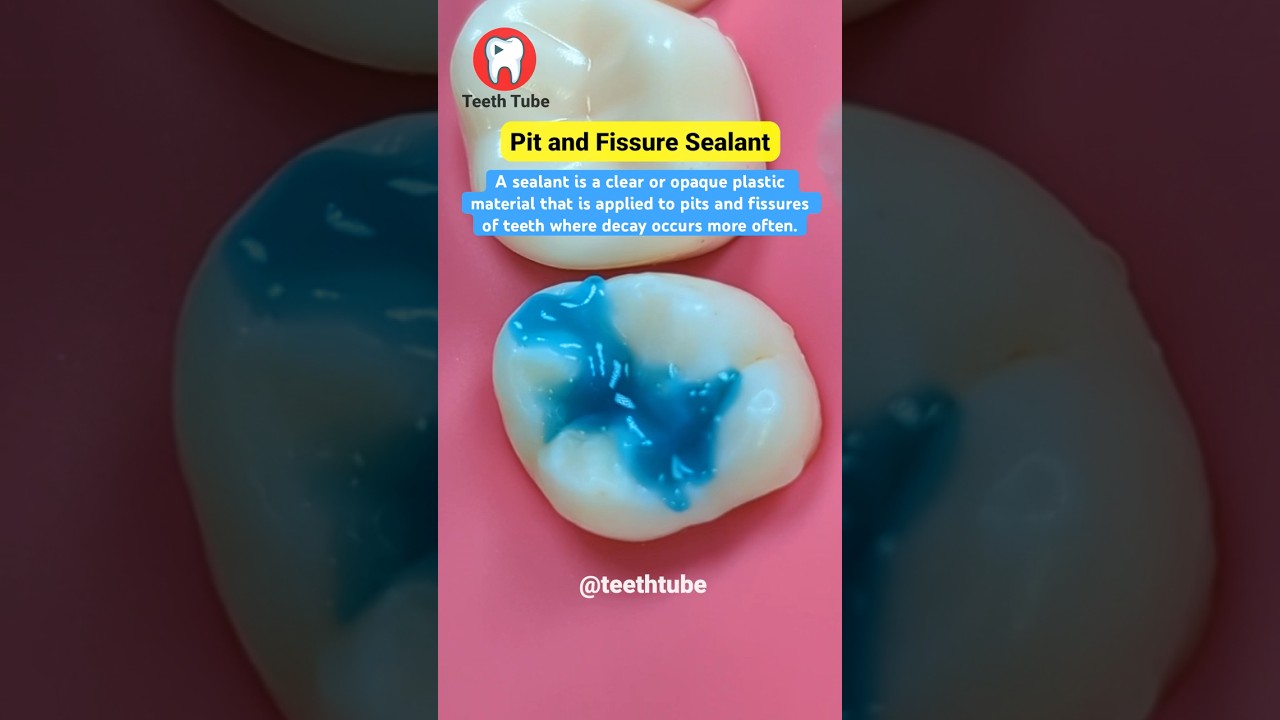 Pit and Fissure Sealant #shorts