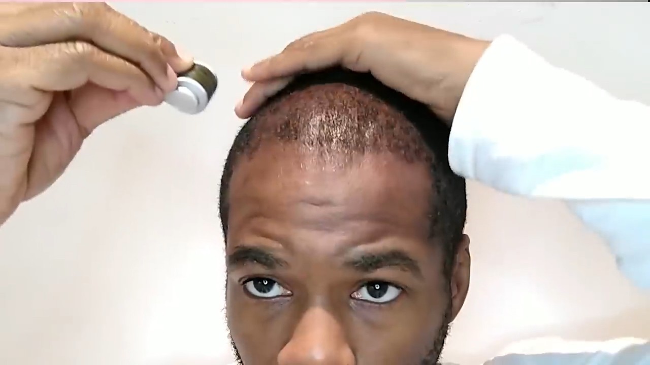 Derma Rolling 101 - Derma Roller Hair Regrowth for BEGINNERS