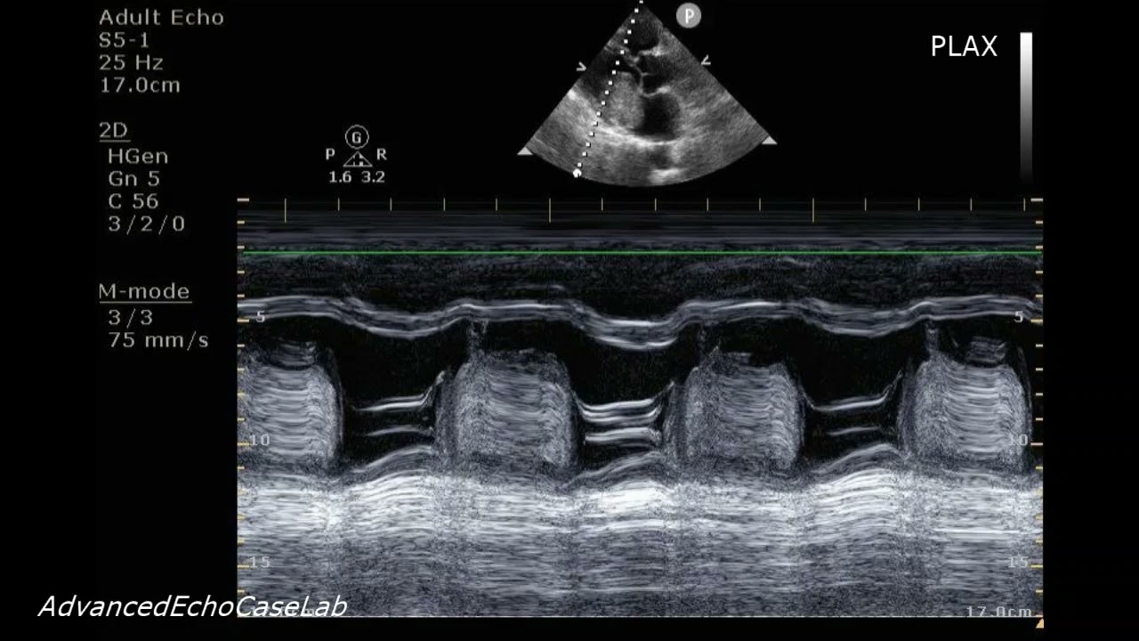 Left Atrial Myxoma: Echocardiographic Visualization from Standard Views.