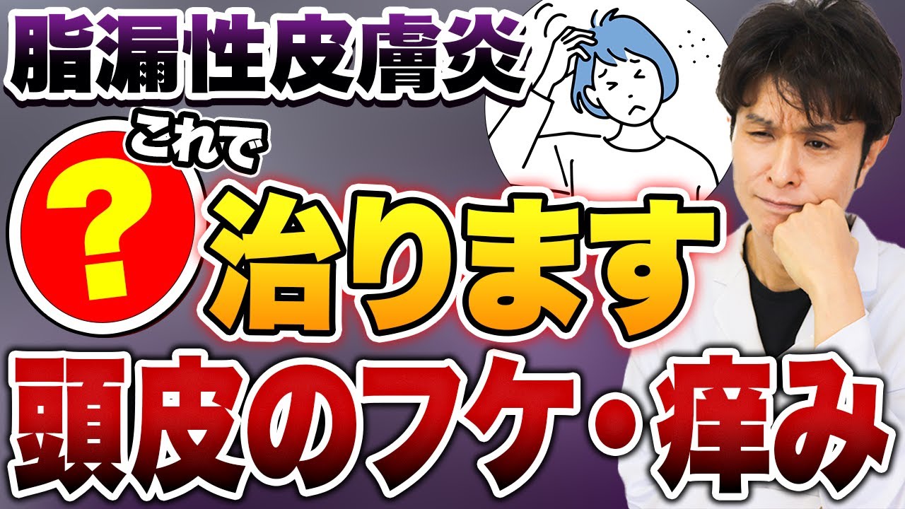 頭皮がかゆい！フケが止まらない！原因はマラセチア？今すぐやめるNG習慣！脂漏性皮膚炎の原因&ldquo;ストレス/食べ物/ホルモン&rdquo;全部話します