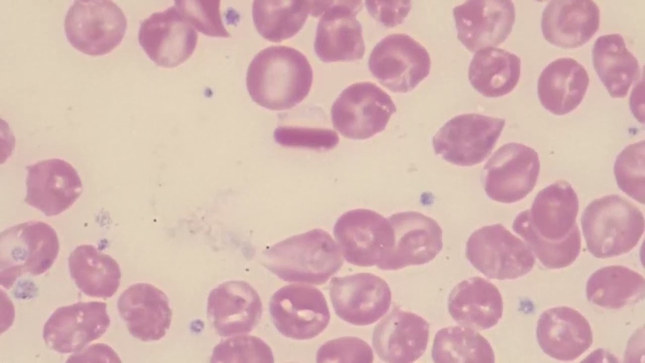 Hemoglobin C Crystals