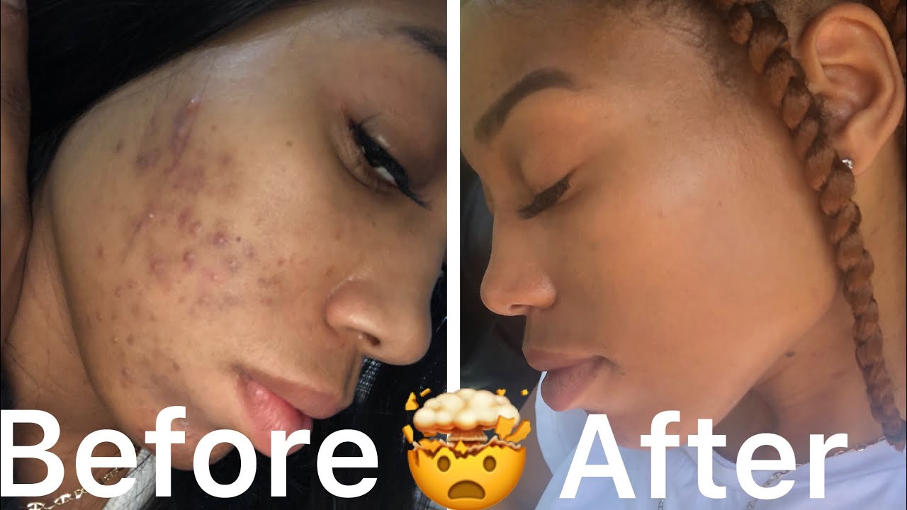 Skin Care Journey| How I cleared my skin| Do’s and DONT’s| Epiduo Forte review