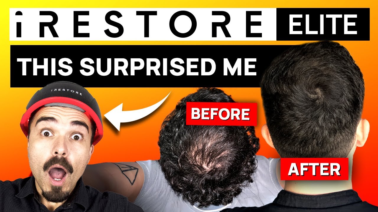 iRESTORE Elite Review: 5 Things to Know for Hair Loss Treatment