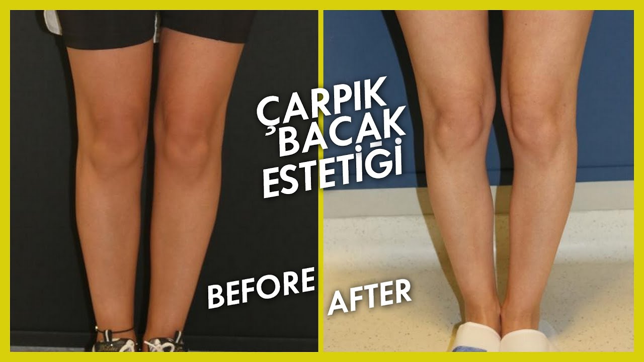 Çarpık Bacak Estetiği Hasta Yorumu - Öncesi ve Sonrası