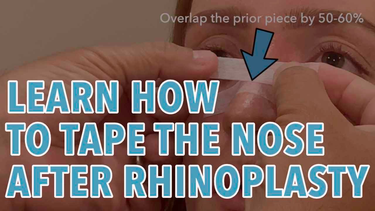 Rhinoplasty Taping