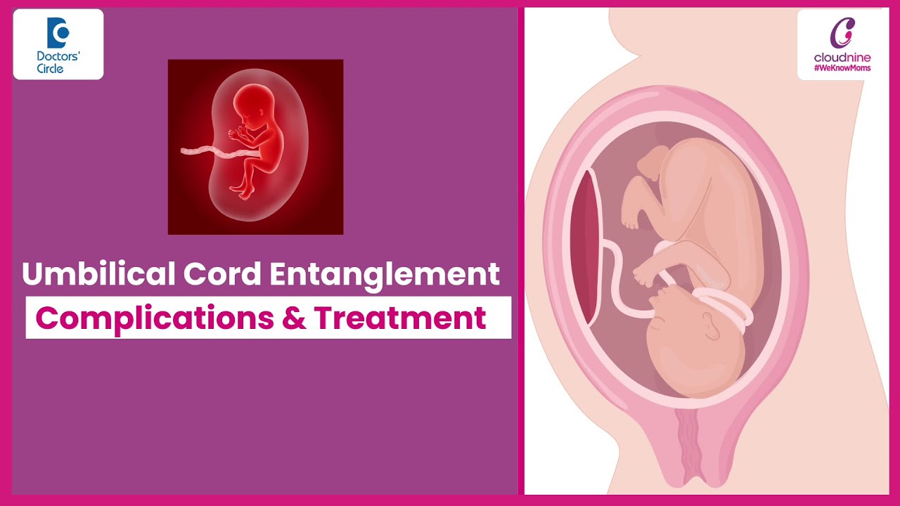 Baby's cord around neck - Normal or Cesarean Delivery?- Dr.Nandyala R Padmapriya | Doctors' Circle