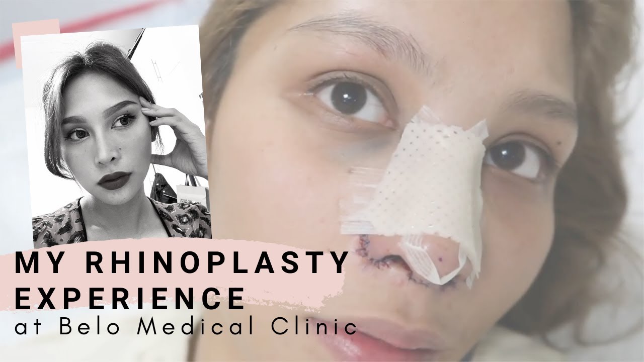 My Nose Job (Rhinoplasty) Experience at Belo Medical Group (Philippines) | Denise Botor