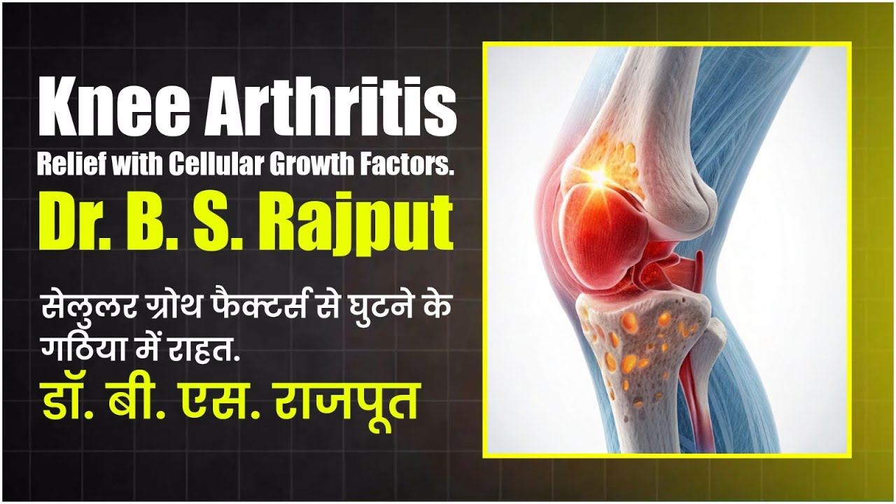 Severe Knee Arthritis Relief with Cellular Growth Factors | Dr. B. S. Rajput’s Advanced Therapy