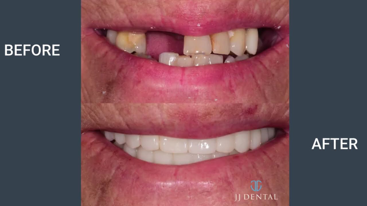 Veneers, Crowns, Implants and more - Smile Makeovers at JJ Dental Fort Lauderdale