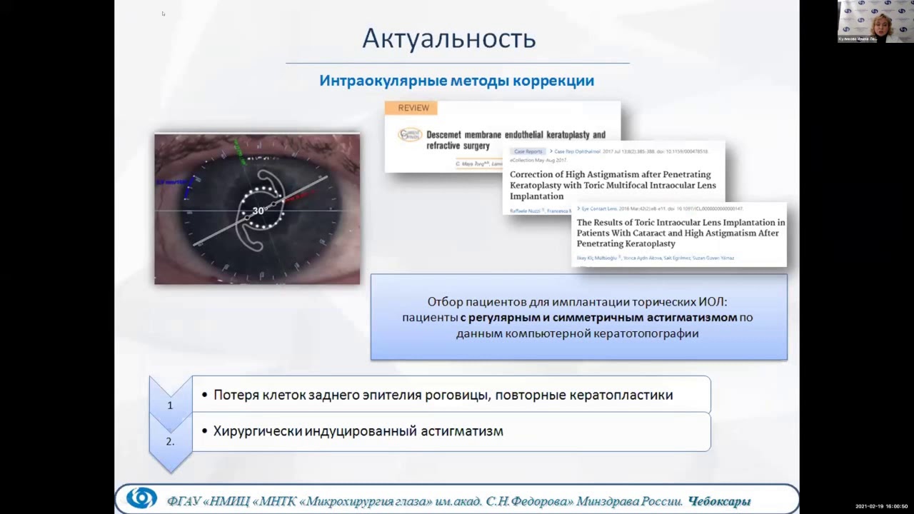 Коррекция посткератопластической аметропии методом имплантации кольца MyoRing