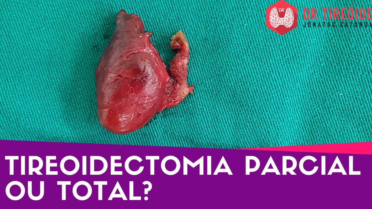 Tireoidectomia parcial ou total? - Dr Tireóide responde #92#