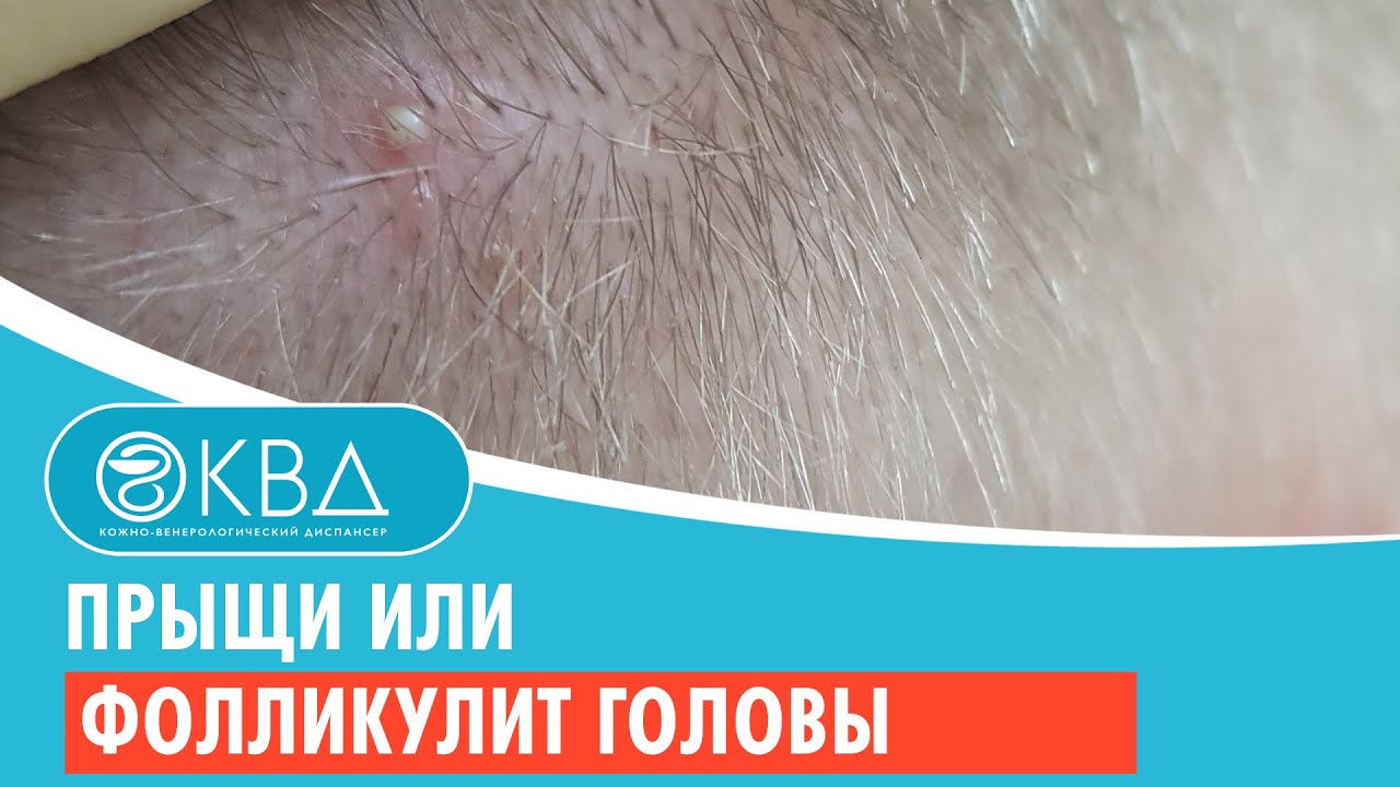 😟 Прыщи или фолликулит головы. Клинический случай №905