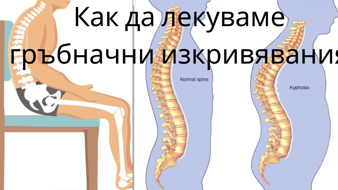 Гръбначни изкривявания и прегърбени рамене лекуване с упражнения вкъщи