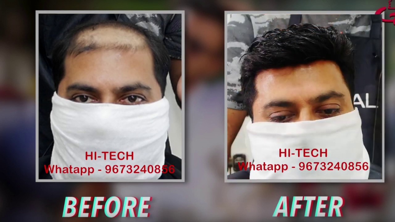 hair replacement video pune  WHATSAPP 9922022913  /9673634255