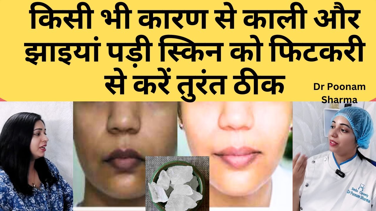किसी भी कारण से काली पड़ चुकी स्किन को फिटकरी  से करे तुरंत साफ़ | Fitkari Se Jhaiyan Kaise Thik Kare