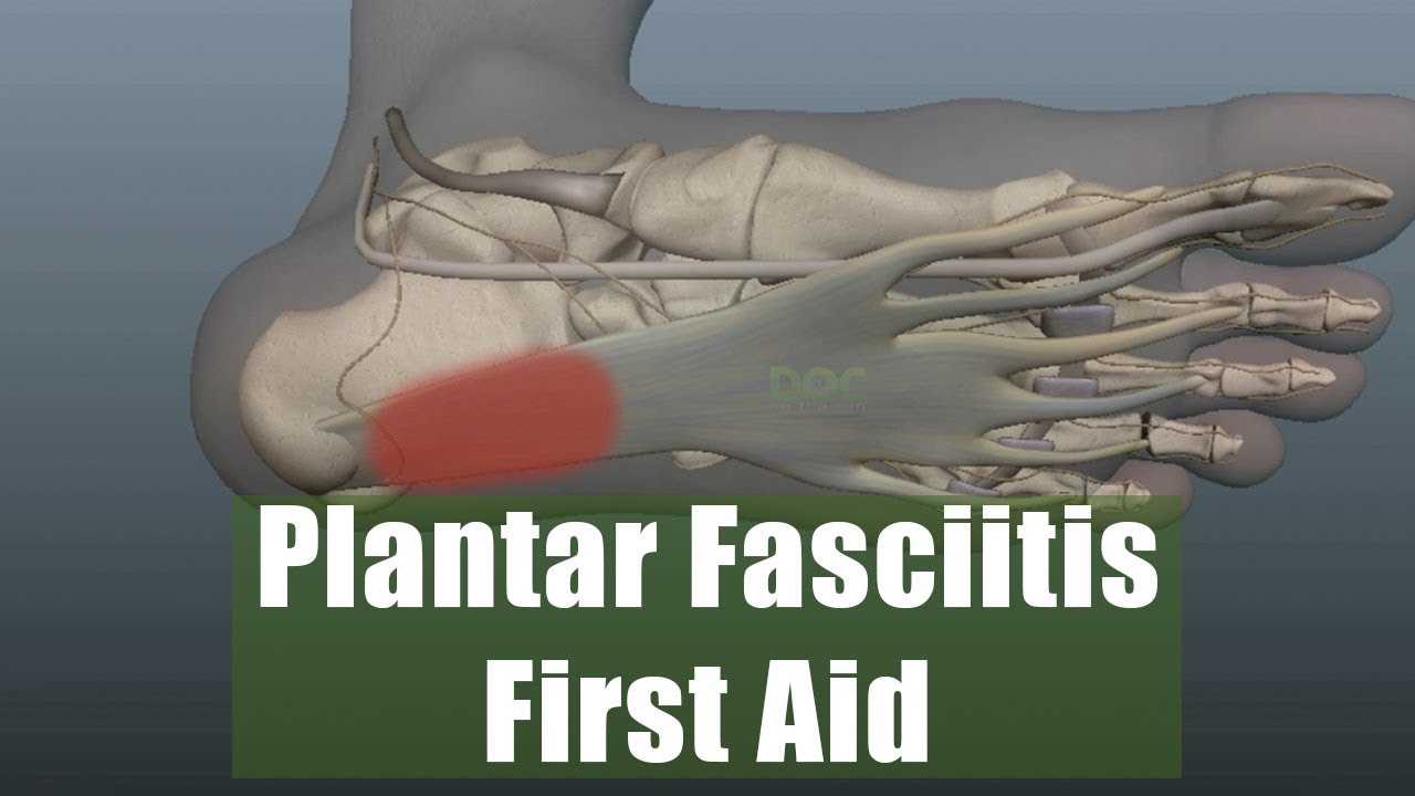 Первая помощь при подошвенном фасциите у бегунов