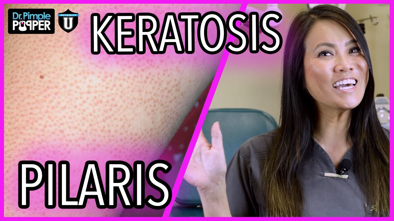 What Are These Bumps On My Skin? | Keratosis Pilaris | with Dr. Sandra Lee