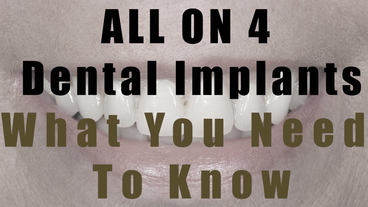 What You Need To Know About All on 4 Dental Implant Treatment incl Costs