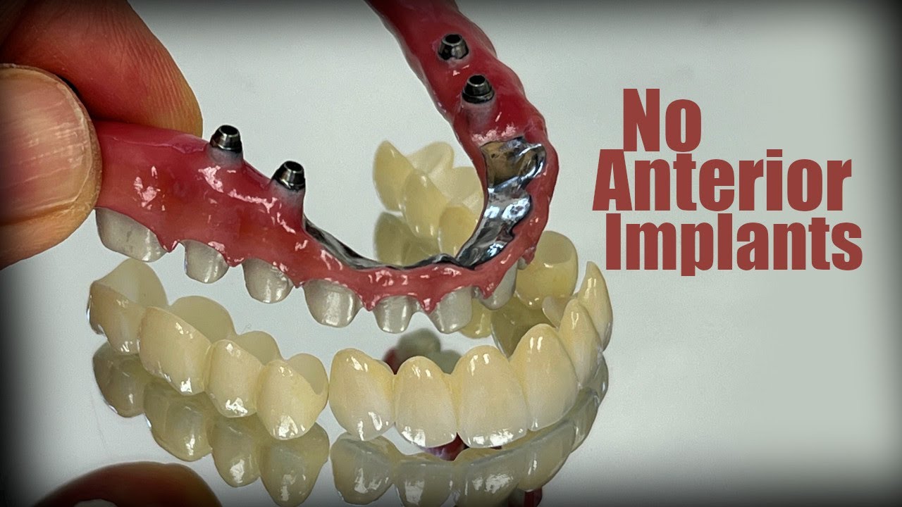 Another 7-Star Case with No Anterior Implants