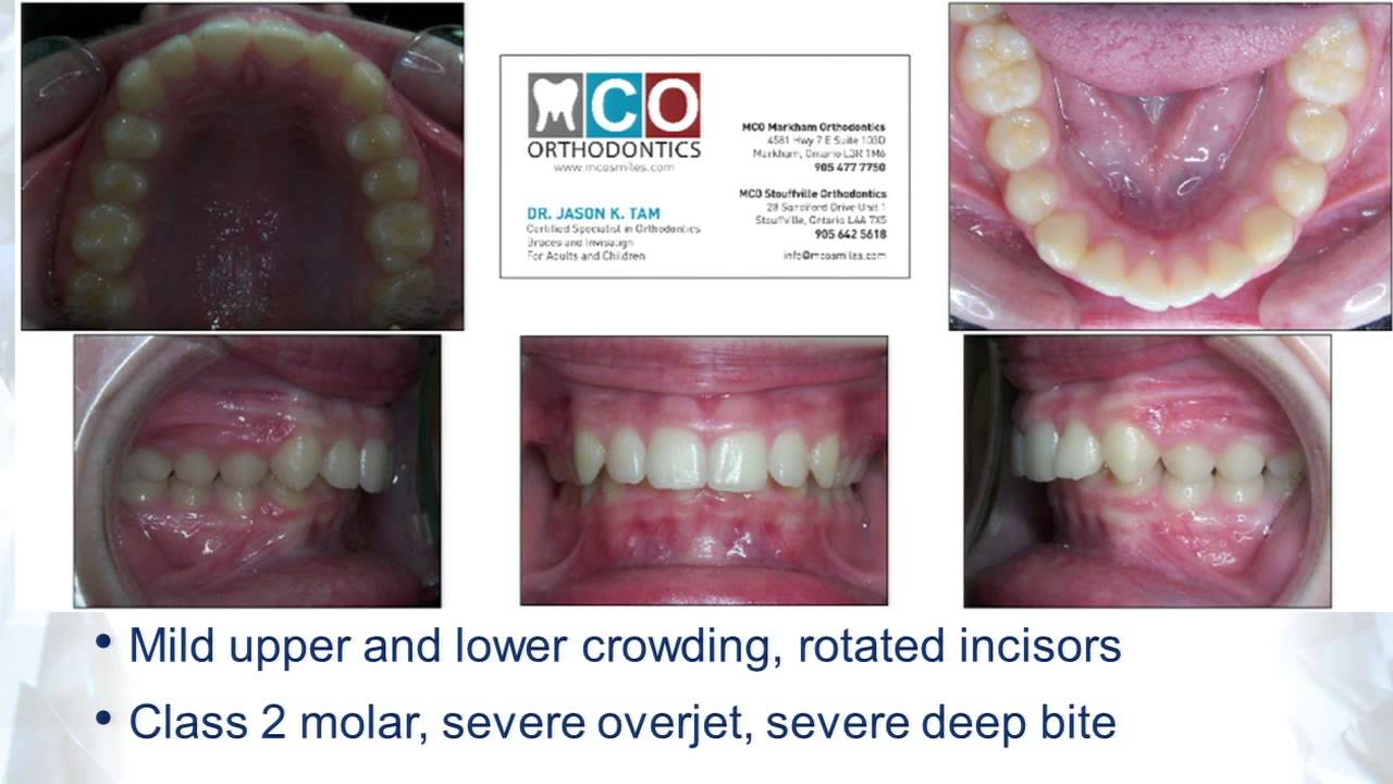 Best Invisalign Result Class 2 overjet, overbite fixed - Toronto Orthodontist Dr. Tam in Las Vegas
