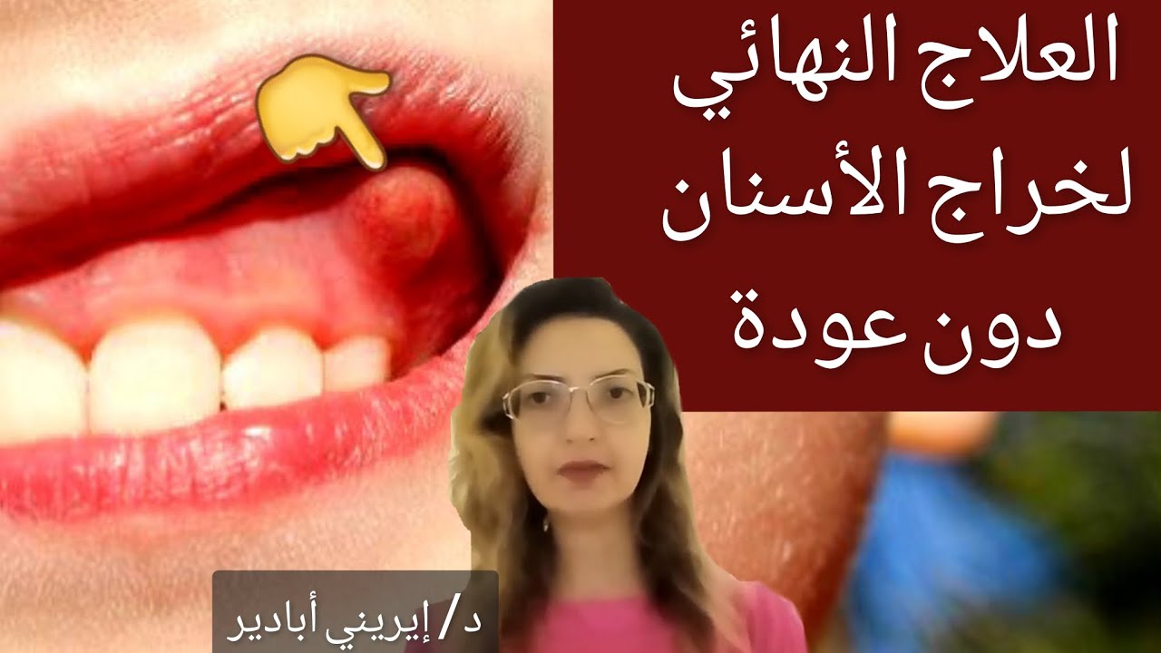 كيفية علاج خراج الأسنان و الضروس نهائياً دون عودة