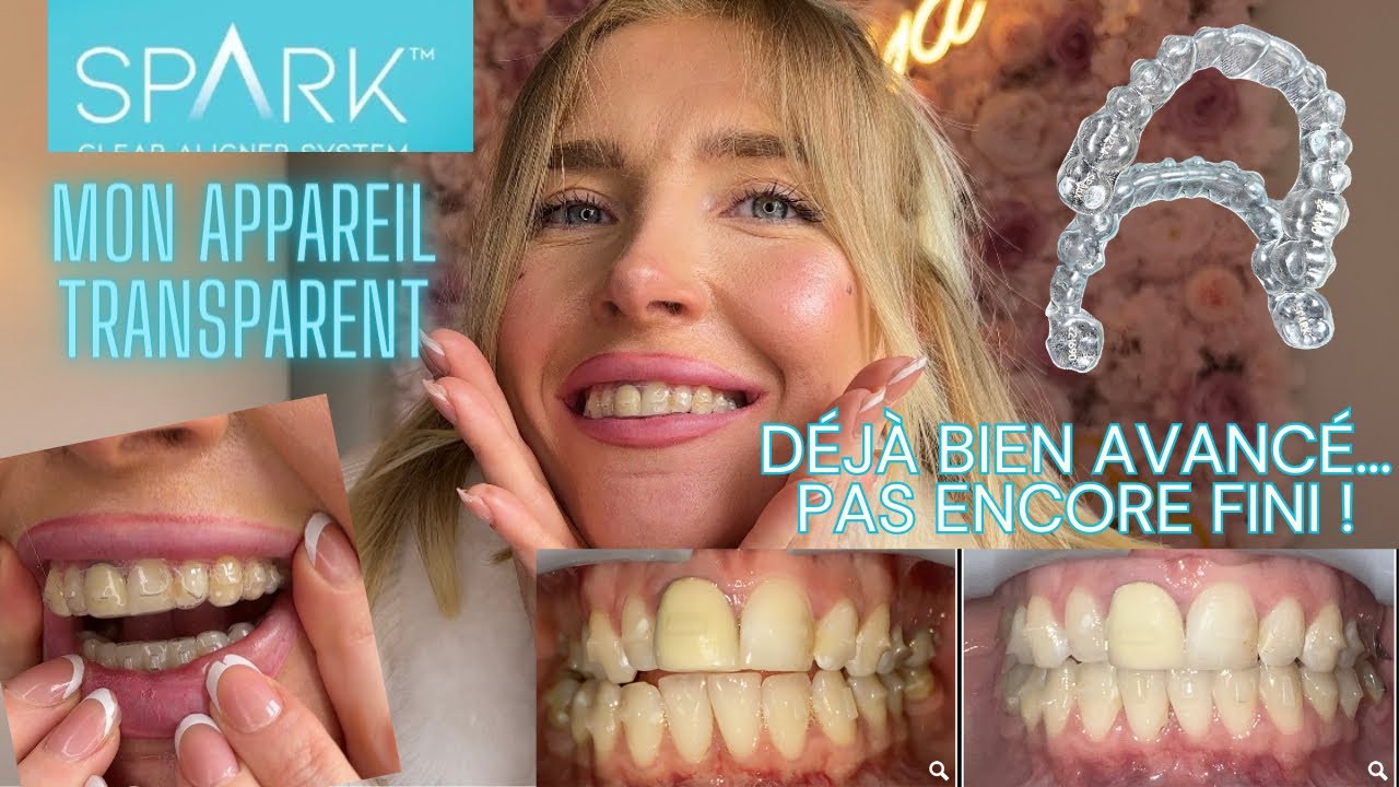 Aligneurs transparent SPARK / résultat rapide et incroyable !!!