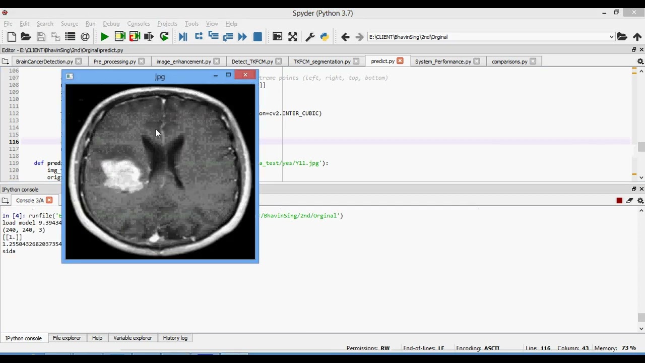 Brain Tumor Segmentation Using Partial Depthwise Separable Convolutions