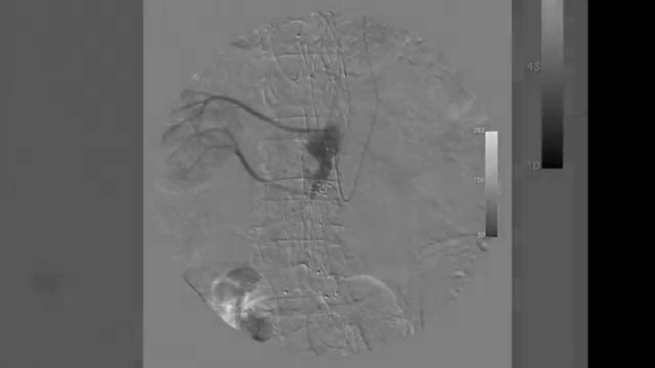 Type II Endoleak