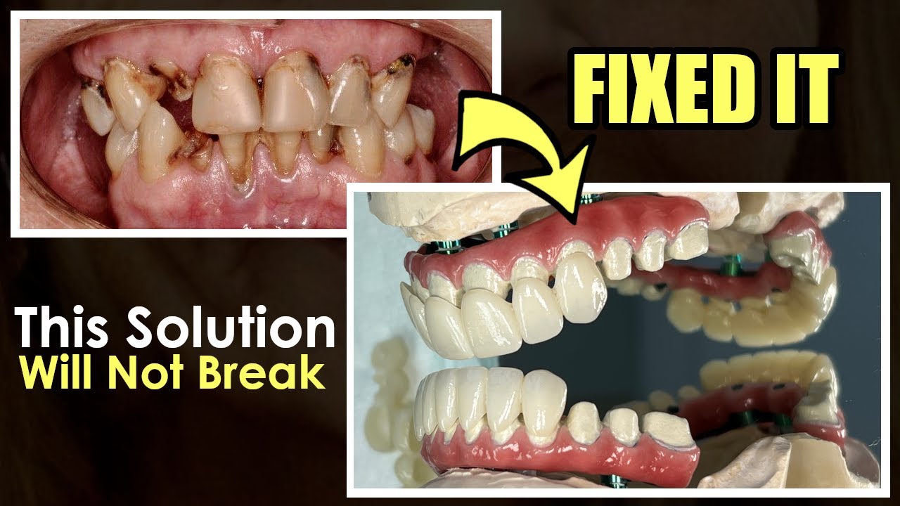 How to Make a Full-Mouth Implant That Stops Ti-Base from Failing