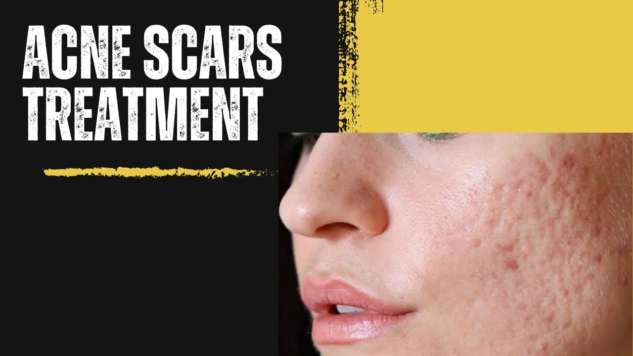 Acne scars and it’s treatment with Oriflame products.