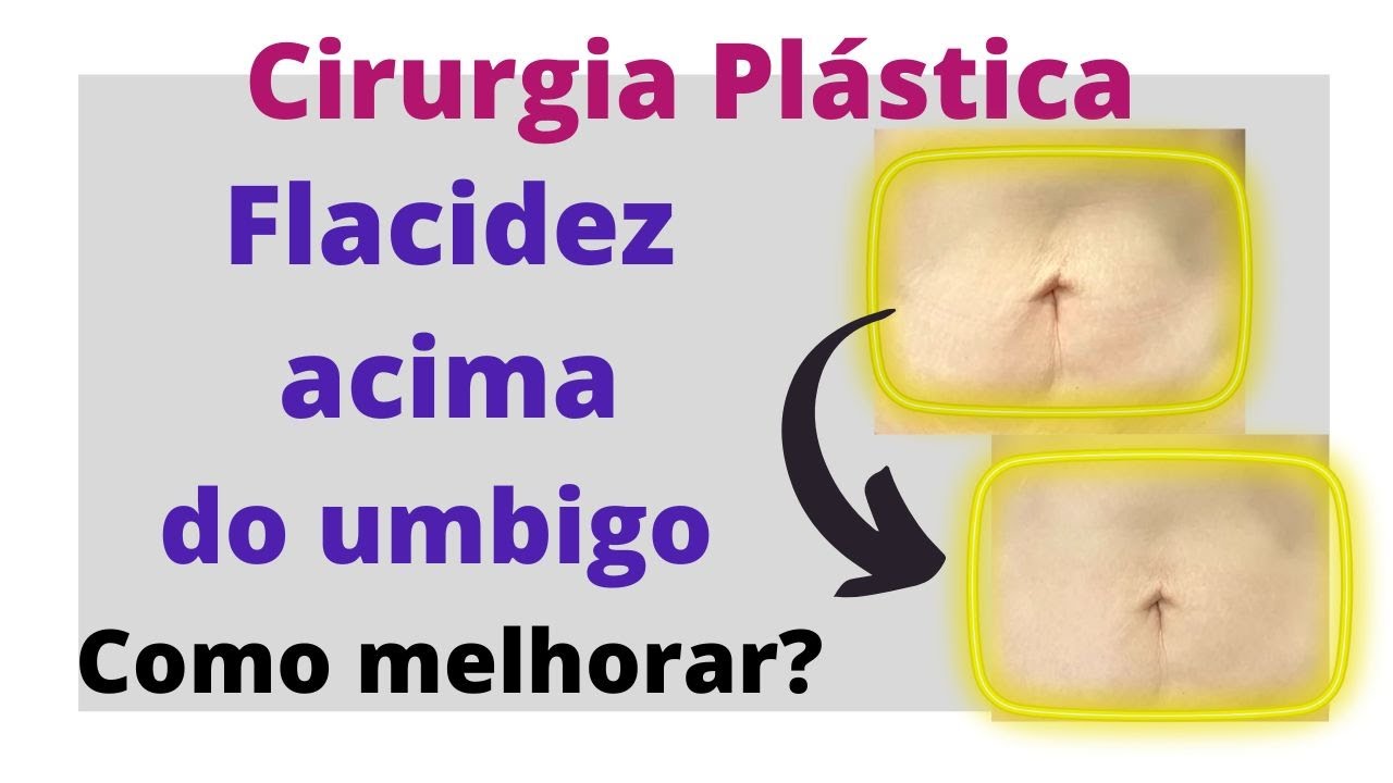 Tratamentos para flacidez acima do umbigo após a cirurgia plástica