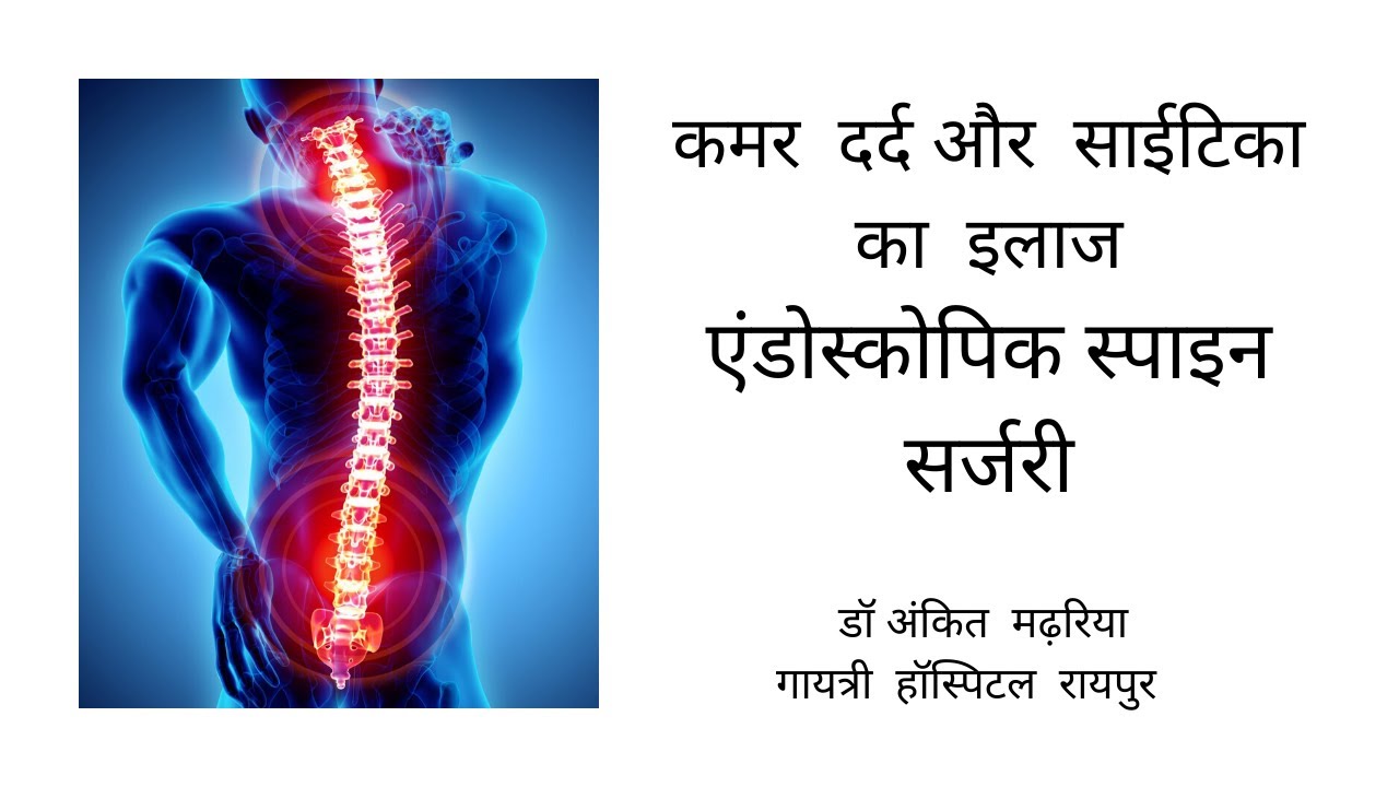 कमर दर्द का इलाज एंडोस्कोपिक स्पाइन सर्जरी द्वारा (छत्तीसगढ़ी में) । Dr Ankit Madharia
