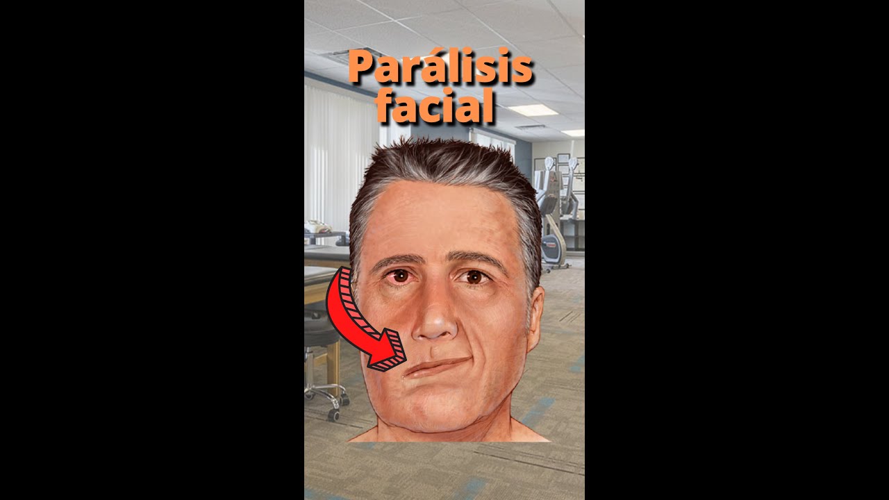Qu&eacute; ejercicios hacer en la Par&aacute;lisis facial