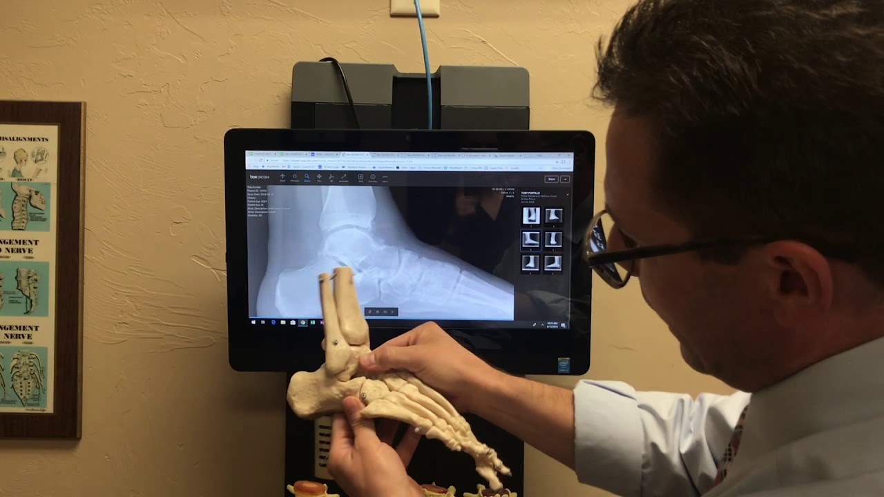 Chronic Ankle Instability with Swelling Fixed by Dr Prince