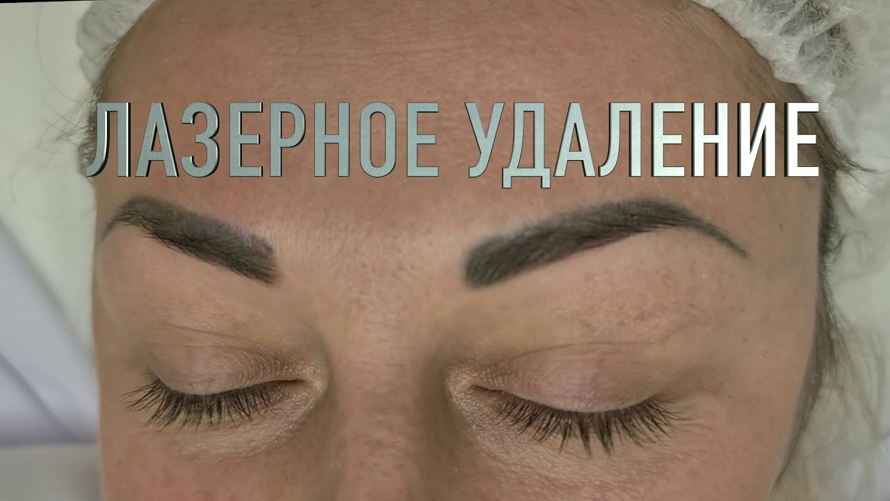 Удаление татуажа бровей неодимовым лазером Киев RUDKO ArtLine